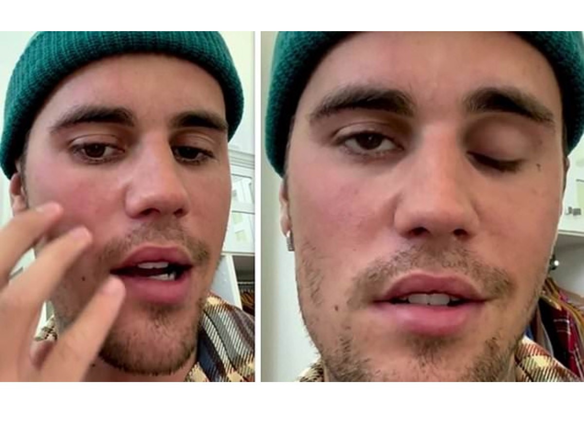 ВИДЕО: Жастин Бибер “нүүрний саажилт” өвчинтэй болсон талаараа мэдэгджээ